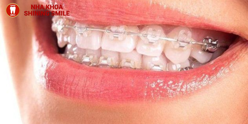 Niềng răng mắc cài sứ giá bao nhiêu: Mới nhất 2024