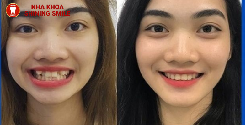 Niềng răng có giúp mặt hết lệch không?