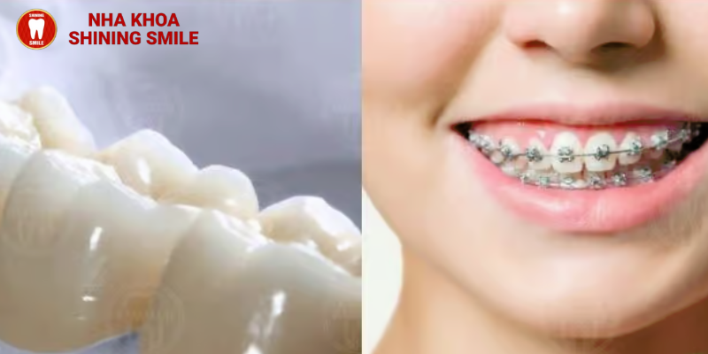 Răng sứ có niềng được không? Lưu ý quan trọng