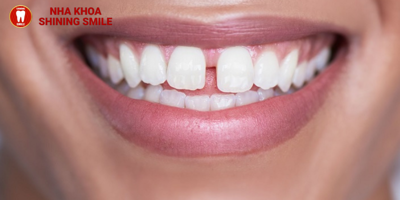 Có thể chỉ niềng 2 răng cửa được không?