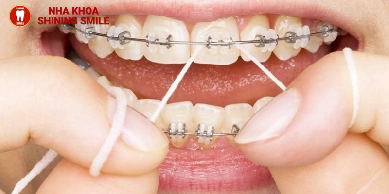 Mẹo Vệ Sinh Răng Niềng Hiệu Quả: Bí Quyết Giữ Răng Sạch Khỏe