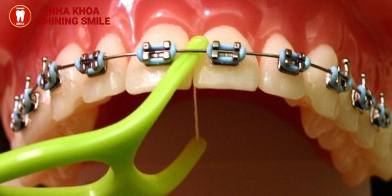 Các lưu ý khi niềng răng: Những điều mà không ai nói cho bạn biết