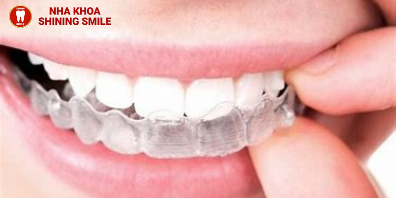  Tất Tần Tật Về Niềng Răng Tháo Lắp: Giải Pháp Hoàn Hảo Cho Nụ Cười Tự Tin