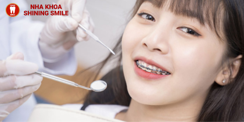 Giá chi tiết cho câu hỏi 17 tuổi niềng răng bao nhiêu tiền