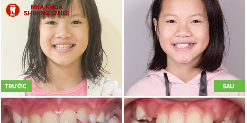 15 tuổi niềng răng hết bao nhiêu tiền? Các cách để tối ưu hóa chi phí