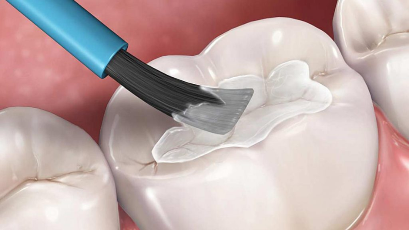 Trám Răng Sứ: Khi Nào Cần Và Quy Trình Thực Hiện