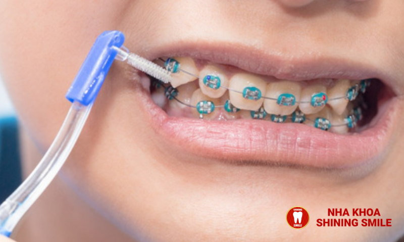 Đang Niềng Răng Mà Bị Sâu Răng: Cách Xử Lý và Phòng Ngừa