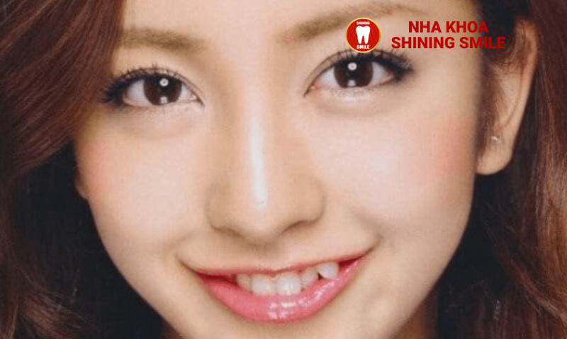 Niềng Răng Khểnh: Cần Nhổ Răng Không và Những Lưu Ý Quan Trọng