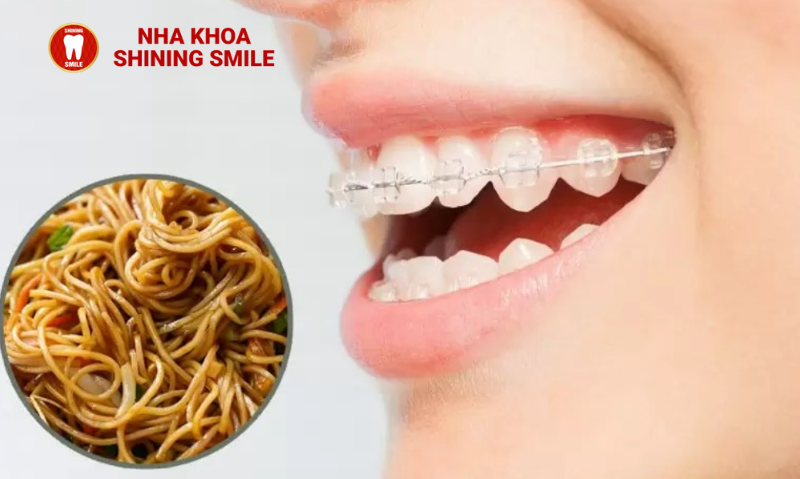 Niềng Răng Ăn Mì Được Không? Lời Khuyên Từ Nha Sĩ