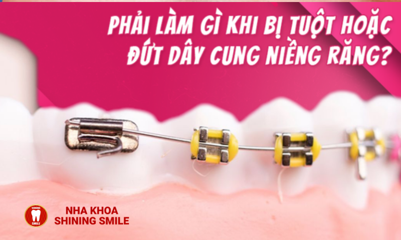 Bung Dây Cung Niềng Răng: Nguyên Nhân và Cách Khắc Phục