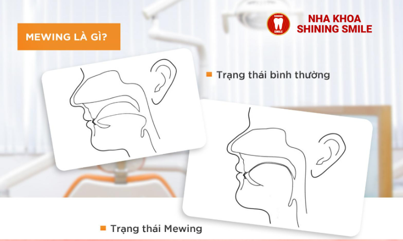Niềng Răng Có Mewing Được Không? Hiểu Rõ Công Nghệ Tiên Tiến