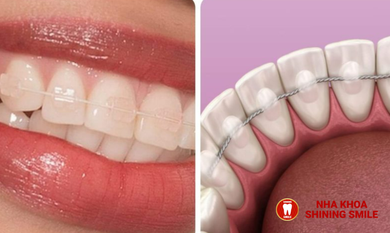 Thời Gian Điều Trị Lệch Khớp Cắn Bằng Niềng Răng: Những Điều Cần Biết