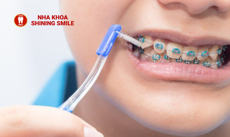 Dụng Cụ Vệ Sinh Răng Niềng: Lựa Chọn Tối Ưu Cho Bạn