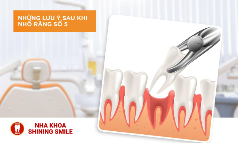 Niềng Răng Nhổ Răng Số 5: Giải Pháp Hoàn Thiện Nụ Cười