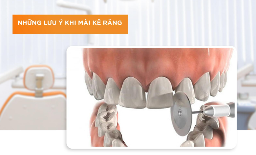 Mài Kẽ Răng Để Niềng Có Hại Không? Lời Khuyên Từ Chuyên Gia