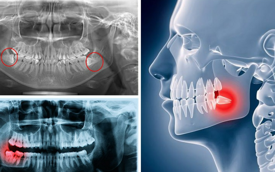 Quyết Định Thời Điểm Nhổ Răng Khôn: Trước Hay Sau Khi Niềng?