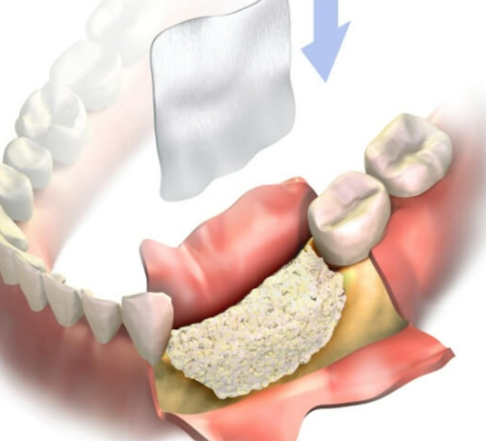 Tiêu Xương Hàm: Liệu Có Thể Niềng Răng Không?