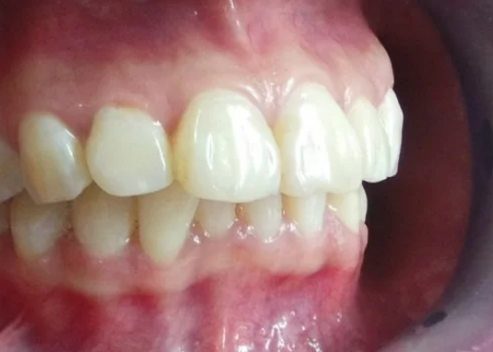 Chỉnh Hàm Hô Nhẹ: Giá Cả và Những Lựa Chọn Phù Hợp