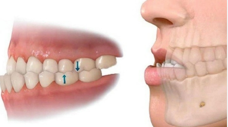 Quy Trình Niềng Răng Móm Chi Tiết: Từ A Đến Z