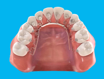 Niềng Răng Brava: Công Nghệ Mới và Những Lợi Ích Nổi Bật