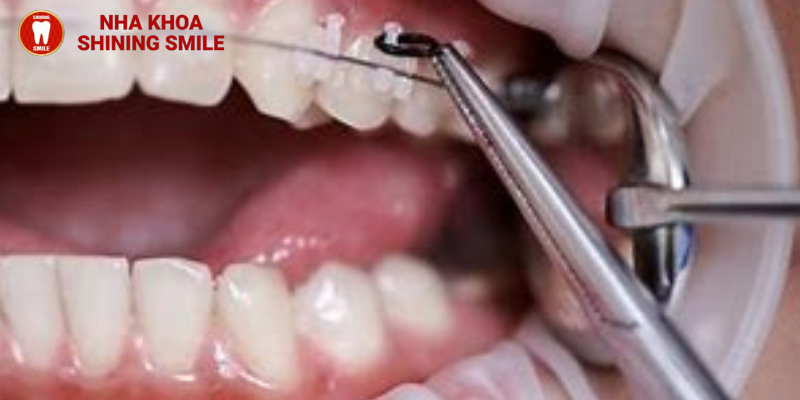 Những điều bạn nên biết về giai đoạn đóng khoảng trong niềng răng