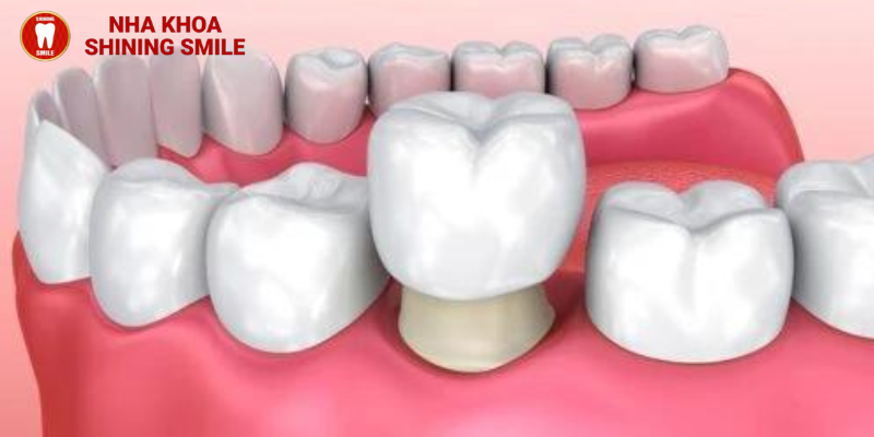 Niềng răng mặt lưỡi: Lựa chọn hoàn hảo