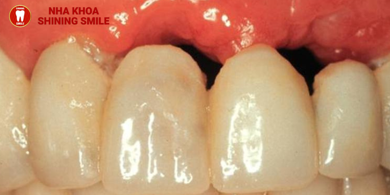 Cách khắc phục nếu thấy dấu hiệu tiêu xương răng khi niềng