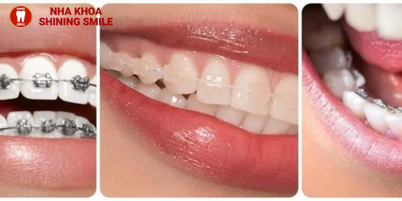 Tất tần tật về chi phí chỉnh lệch 1 răng