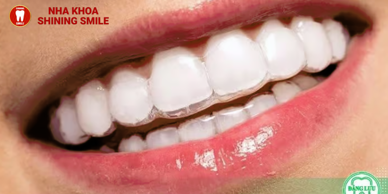 Những điều có thể bạn chưa biết về chi phí nẹp răng