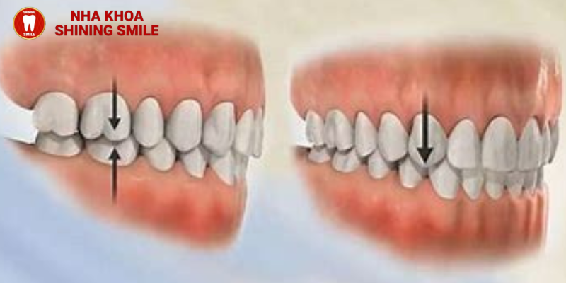 Năng khớp cắn trong niềng răng: Tác dụng thần kỳ mà bạn chưa biết