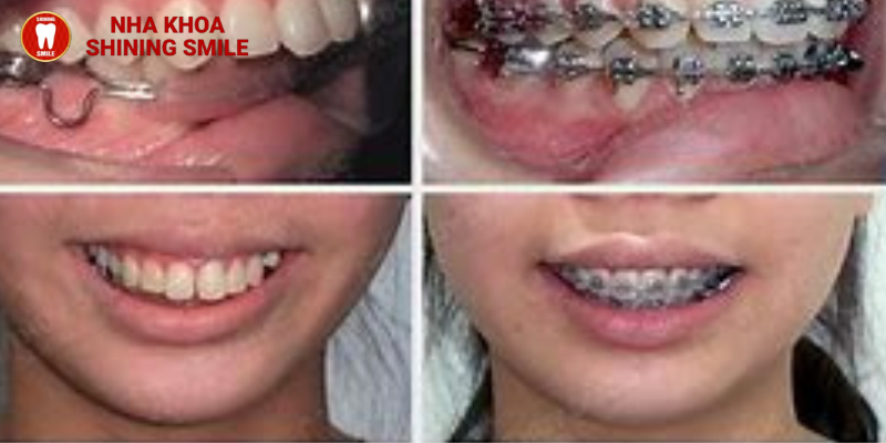 Niềng răng khớp cắn ngược: Những quy trình đằng sau sự hoàn hảo