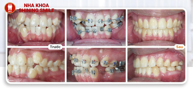 Thời gian chính xác cho câu hỏi niềng răng bao lâu thì răng bắt đầu dịch chuyển