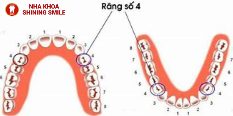 Có nên nhổ răng số 4 để niềng không?