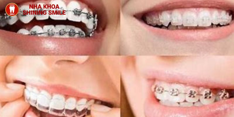 Những điều bạn nên biết về niềng răng khớp cắn sâu