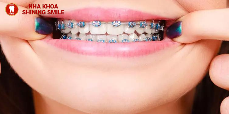 Nguyên nhân khiến răng lung lay khi niềng