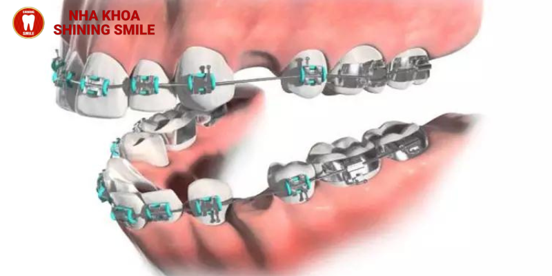 Niềng răng mắc cài kim loại: Bí quyết cho nụ cười rạng ngời cùng SHINING SMILE