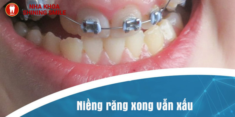 Niềng răng xong vẫn xấu: Nguyên nhân tiềm ẩn