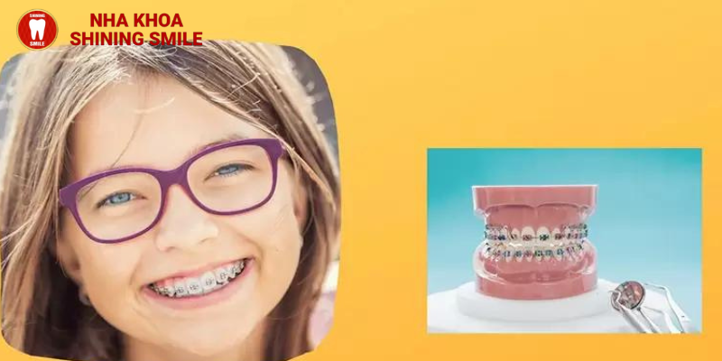 Những điều bạn cần biết về siết răng khi niềng