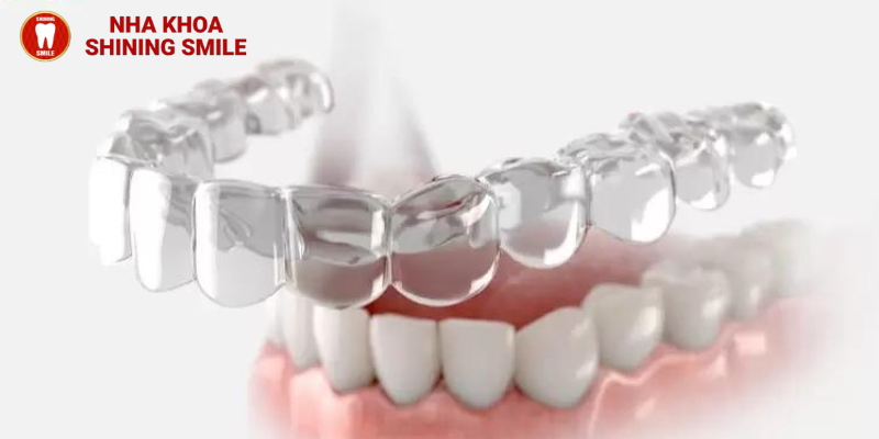 Đeo hàm duy trì vẫn bị chạy răng: Nguyên nhân và cách khắc phục