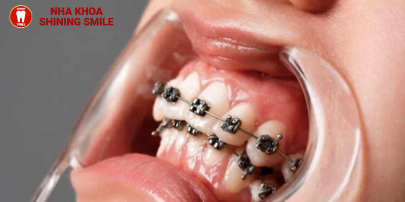 Nguyên nhân niềng răng xong bị hô