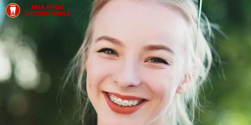 Niềng răng có giúp mũi cao hơn không? Những sự thay đổi trên khuôn mặt khi niềng
