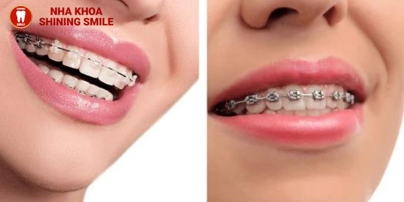 So sánh mắc cài sứ và kim loại