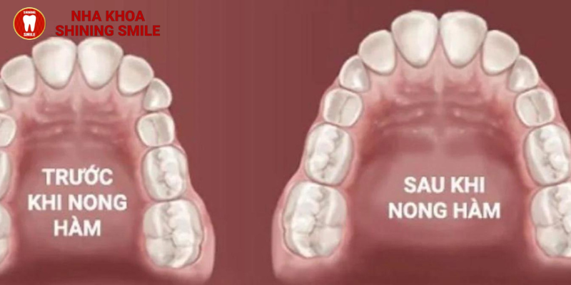 Tất Tần Tật Về Nong Hàm Khi Niềng Răng: Giải Pháp Hiệu Quả Từ SHINING SMILE