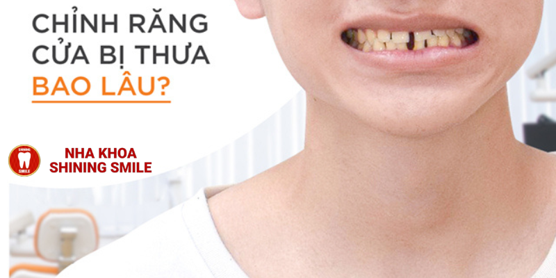Giải Pháp Hiệu Quả Cho Răng Cửa Thưa Cùng SHINING SMILE