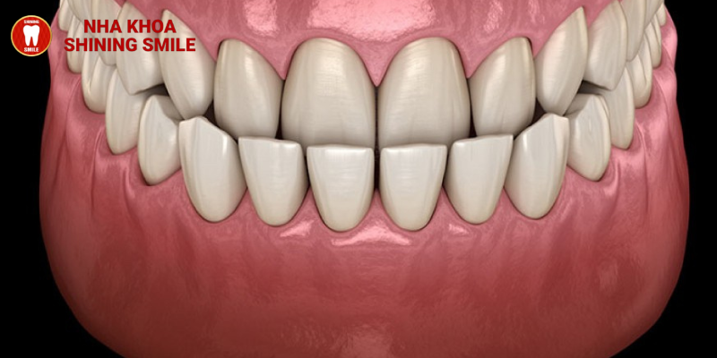Chi Phí Niềng Răng Khớp Cắn Ngược Tại SHINING SMILE: Đầu Tư Cho Nụ Cười Hoàn Hảo
