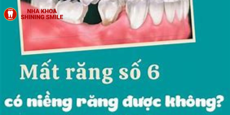 Mất Răng Số 6 Có Niềng Được Không? Giải Đáp Cùng SHINING SMILE