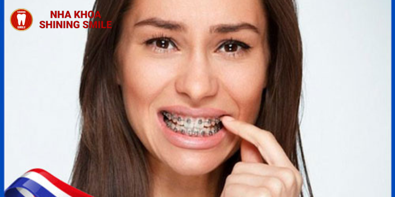 Giảm Đau Khi Niềng Răng: Bí Quyết Từ SHINING SMILE