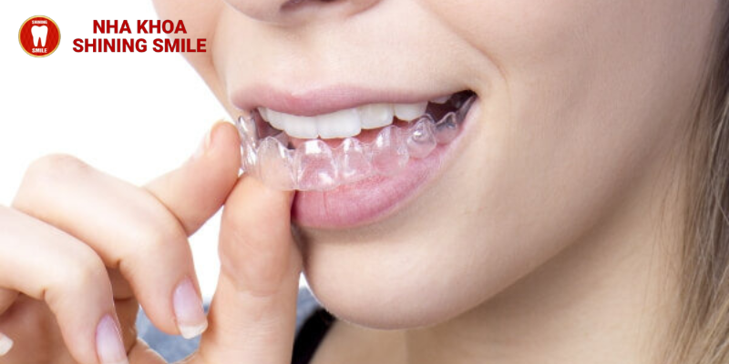 Niềng Răng Trong Suốt Mất Bao Lâu? Khám Phá Cùng SHINING SMILE