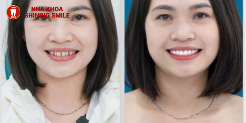 Bí Mật Giấu Kín về Giá Làm Khít Răng Thưa tại SHINING SMILE