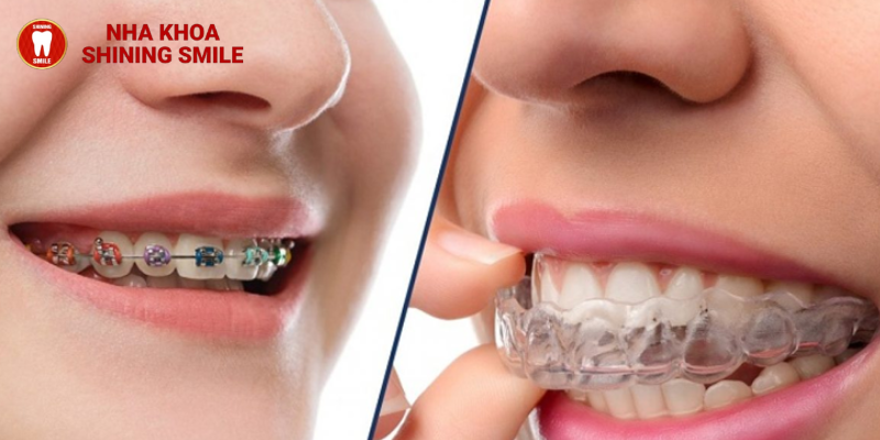 Làm Đẹp Nụ Cười Với Niềng Răng: Suốt hay Mắc Cài? SHINING SMILE Tư Vấn Chuyên Sâu!